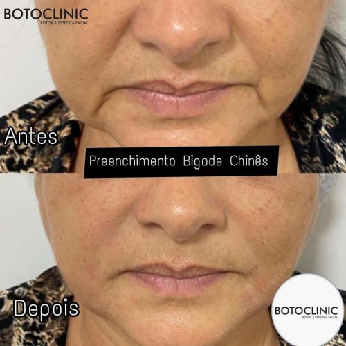 Botoclinic Valinhos Clínica de Estética SP