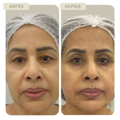 Botoclinic Valinhos Clínica de Estética SP